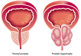 Diferencia entre una próstata sana y una con HBP