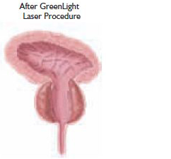 Próstata recuperada tras la aplicación del láser verde KTP